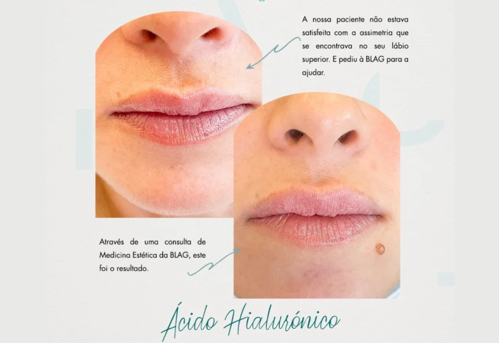 Toxina Botulínica e Ácido Hialurónico: O que são e quais as suas diferenças?