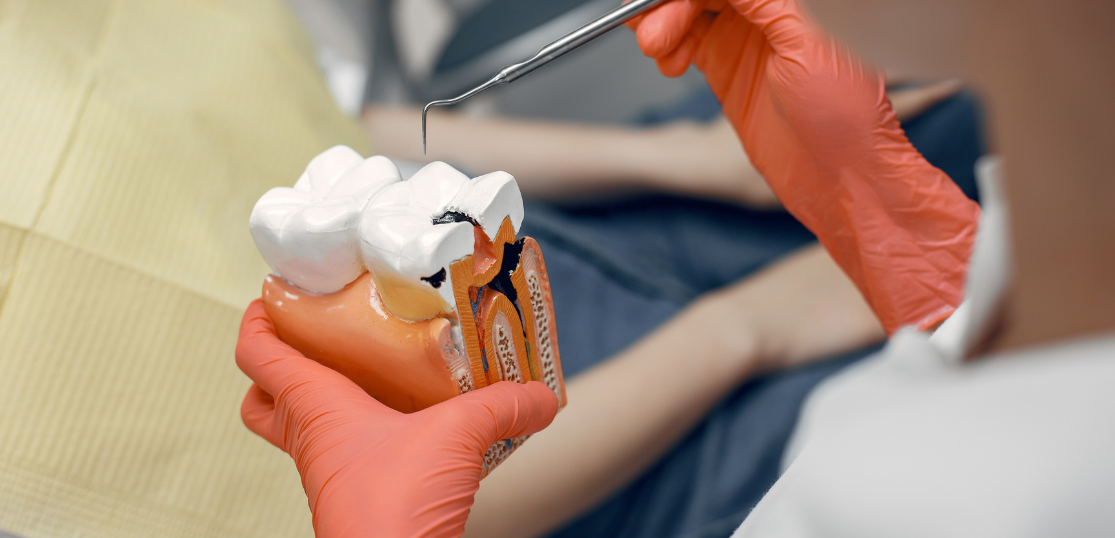 Desvitalizar um dente: tratamento endodôntico para preservar o dente natural